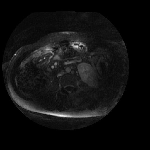 Acinar cell carcinoma of the pancreas (Radiopaedia 75442-86668 Axial T1 C+ fat sat 4).jpg