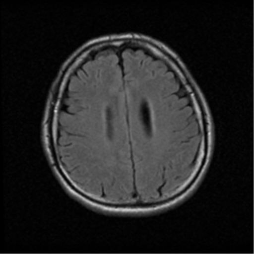 File:Acoustic schwannoma (Radiopaedia 39170-41387 Axial FLAIR 16).png