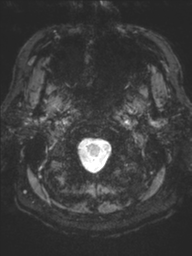 Acoustic schwannoma (Radiopaedia 55729-62281 Axial SWI 1).png