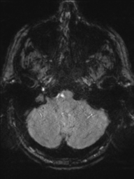 File:Acoustic schwannoma (Radiopaedia 55729-62281 Axial SWI 8).png