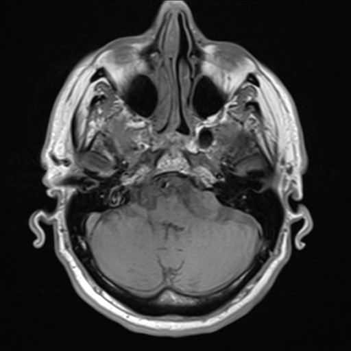 File:Acoustic schwannoma (Radiopaedia 55729-62281 T1 5).png