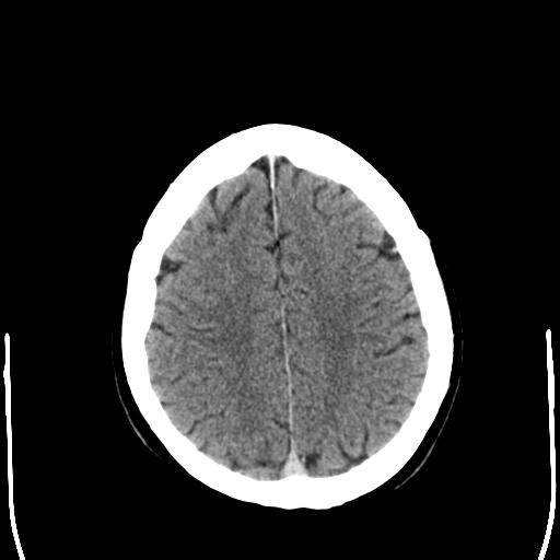 File:Acoustic schwannoma - cystic (Radiopaedia 29487-29980 AXIAL THICK non-contrast 21).jpg
