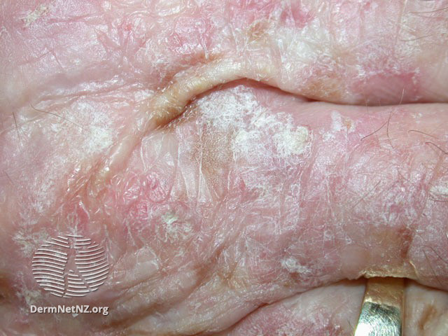 File:Actinic keratoses (DermNet NZ lesions-sk5).jpg
