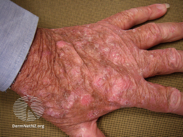 File:Actinic keratoses affecting the hands (DermNet NZ lesions-ak-hands-293).jpg