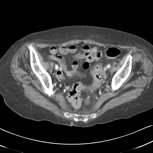 Active bleeding from duodenal ulcer with embolization (Radiopaedia 34216-35481 C 54).png