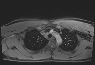 File:Active right ventricular cardiac sarcoidosis (Radiopaedia 55596-62100 Axial Post contrast Dixon 9).jpg