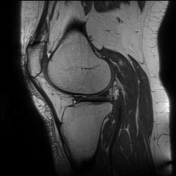 File:Acute-on-chronic transient lateral patellar dislocation with trochlear dysplasia (Radiopaedia 84099-99349 Sagittal PD 108).jpg