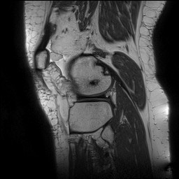 Acute-on-chronic transient lateral patellar dislocation with trochlear dysplasia (Radiopaedia 84099-99349 Sagittal PD 125).jpg