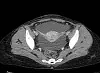 Acute Budd-Chiari syndrome (Radiopaedia 60858-68638 A 259).jpg