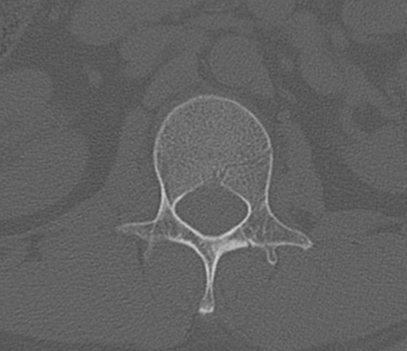 File:Acute L1 burst compression fracture (Radiopaedia 34430-35755 Axial bone window 23).png