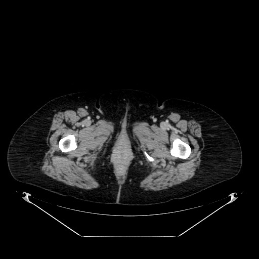 Acute appendicitis, heterotaxy syndrome (Radiopaedia 66884-76202 Axial C+ portal venous phase 141).jpg