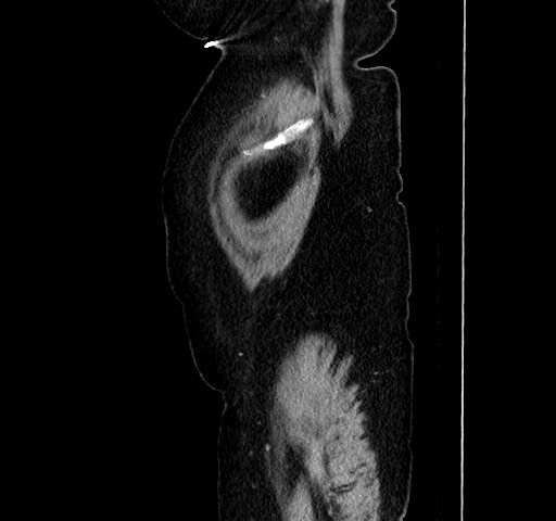 File:Acute appendicitis, heterotaxy syndrome (Radiopaedia 66884-76202 Sagittal C+ portal venous phase 19).jpg