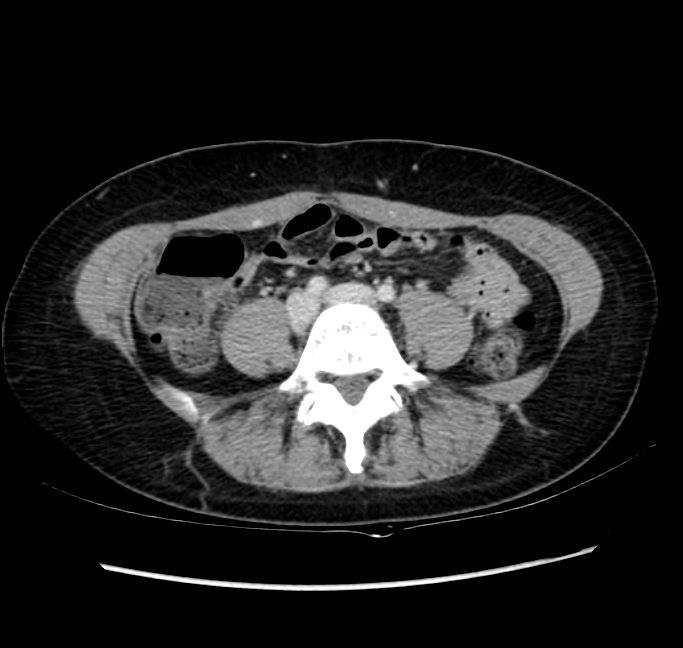 Acute appendicitis (Radiopaedia 22892-22918 Axial C+ portal venous phase 52).png