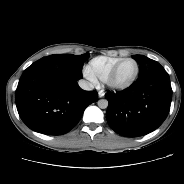 Acute appendicitis (Radiopaedia 27049-27227 Axial C+ portal venous phase 1).jpg