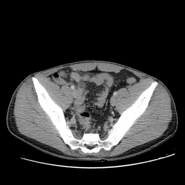 Acute appendicitis (Radiopaedia 27049-27227 Axial C+ portal venous phase 61).jpg