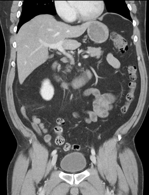 Acute appendicitis (Radiopaedia 36611-38177 Coronal C+ portal venous phase 30).png