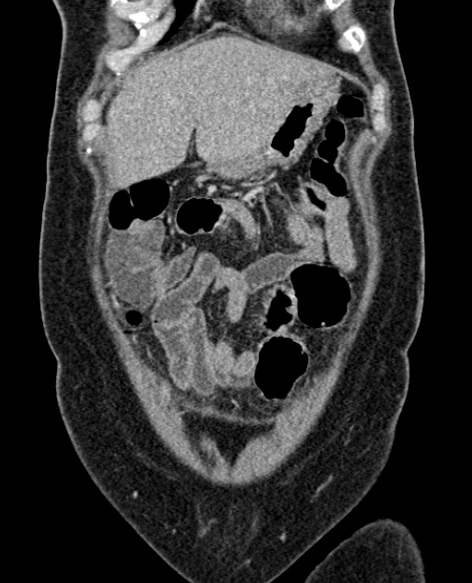 File:Acute appendicitis (Radiopaedia 48792-53822 Coronal C+ portal venous phase 60).jpg