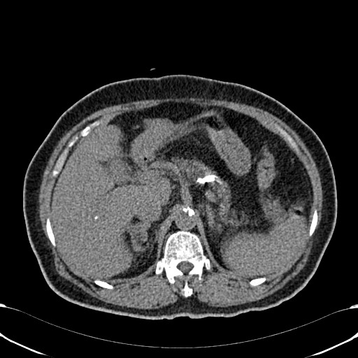 File:Acute appendicitis (Radiopaedia 58627-65818 Axial non-contrast 25).jpg