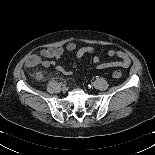 Acute appendicitis (Radiopaedia 58627-65818 Axial non-contrast 64).jpg