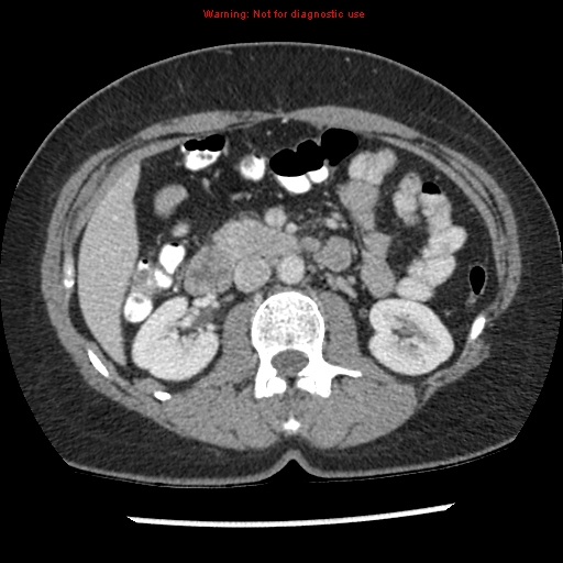 File:Acute appendicitis (Radiopaedia 7966-8812 C+ portal venous phase 16).jpg