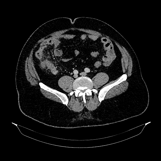 Acute appendicitis (Radiopaedia 79950-93224 Axial C+ portal venous phase 70).jpg