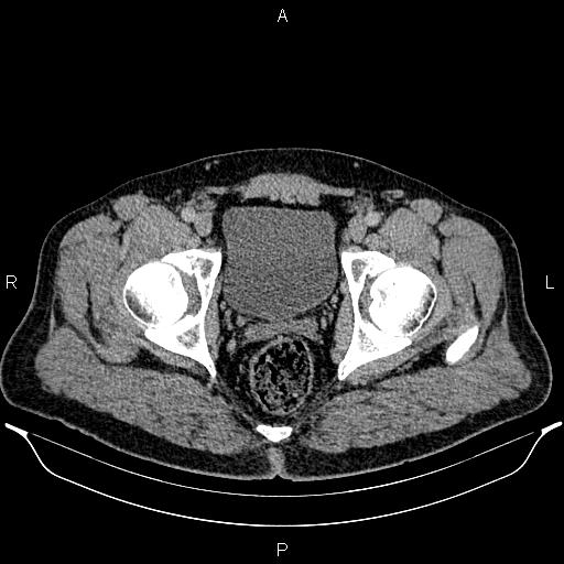 File:Acute appendicitis (Radiopaedia 84780-100240 Axial C+ portal venous phase 104).jpg