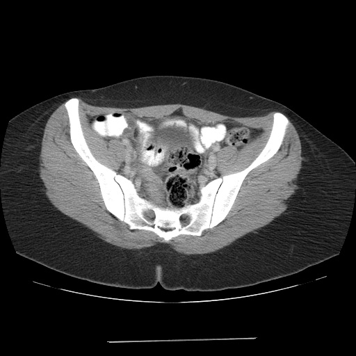 File:Acute appendicitis (Radiopaedia 9417-10099 Axial C+ portal venous phase 8).jpg