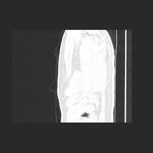 Acute appendicitis and COVID 19 pneumonia (Radiopaedia 76604-88380 Sagittal lung window 8).jpg