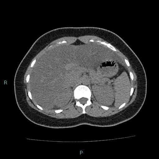 Acute bilateral pyelonephritis (Radiopaedia 37146-38881 Axial non-contrast 29).jpg