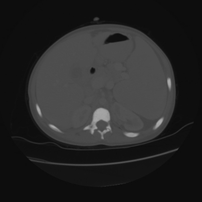 File:Acute calculous cholecystitis in patient with osteopetrosis (Radiopaedia 77871-90159 Axial bone window 16).jpg
