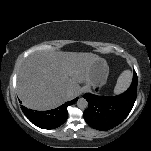 File:Acute cholecystitis and ureteric colic (Radiopaedia 42330-45444 Axial prone 2).jpg