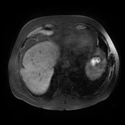 Acute cholecystitis complicated by pylephlebitis (Radiopaedia 65782-74915 Axial T1 fat sat 6).jpg