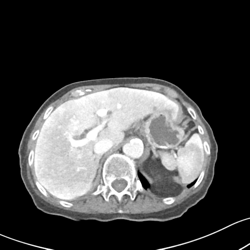 Acute cholecystitis with contained perforation (Radiopaedia 47328-51907 Axial C+ portal venous phase 18).png