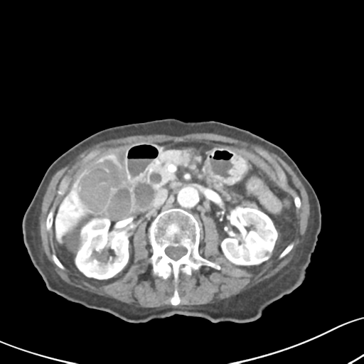 File:Acute cholecystitis with contained perforation (Radiopaedia 47328-51907 Axial C+ portal venous phase 29).png