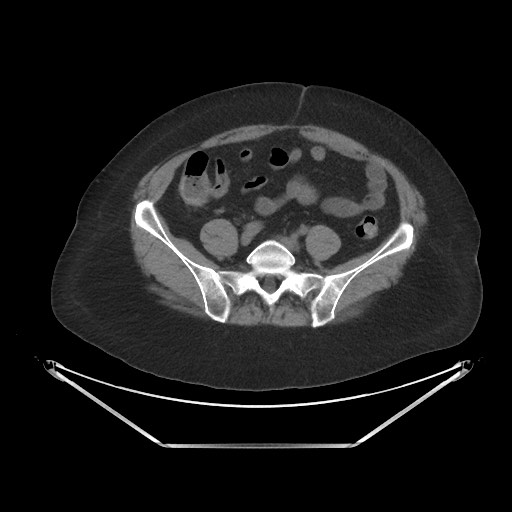 Acute cholecystitis with tensile fundus sign (Radiopaedia 71394-81723 Axial non-contrast 80).jpg