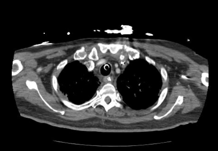 Acute cor pulmonale (ultrasound) (Radiopaedia 83508-98818 Axial C+ CTPA 9).jpg