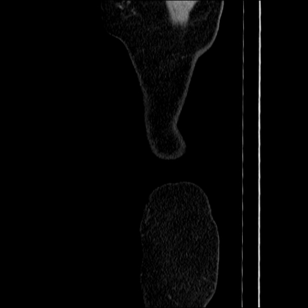 Acute diverticulitis (Radiopaedia 34183-35442 Sagittal C+ portal venous phase 104).jpg