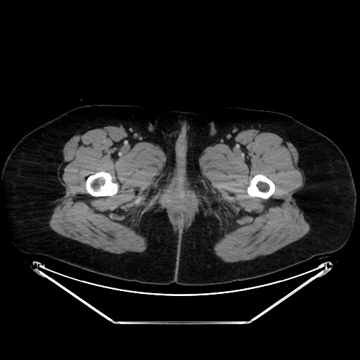 Acute diverticulitis - transverse colon (Radiopaedia 87063-103327 Axial C+ portal venous phase 187).jpg