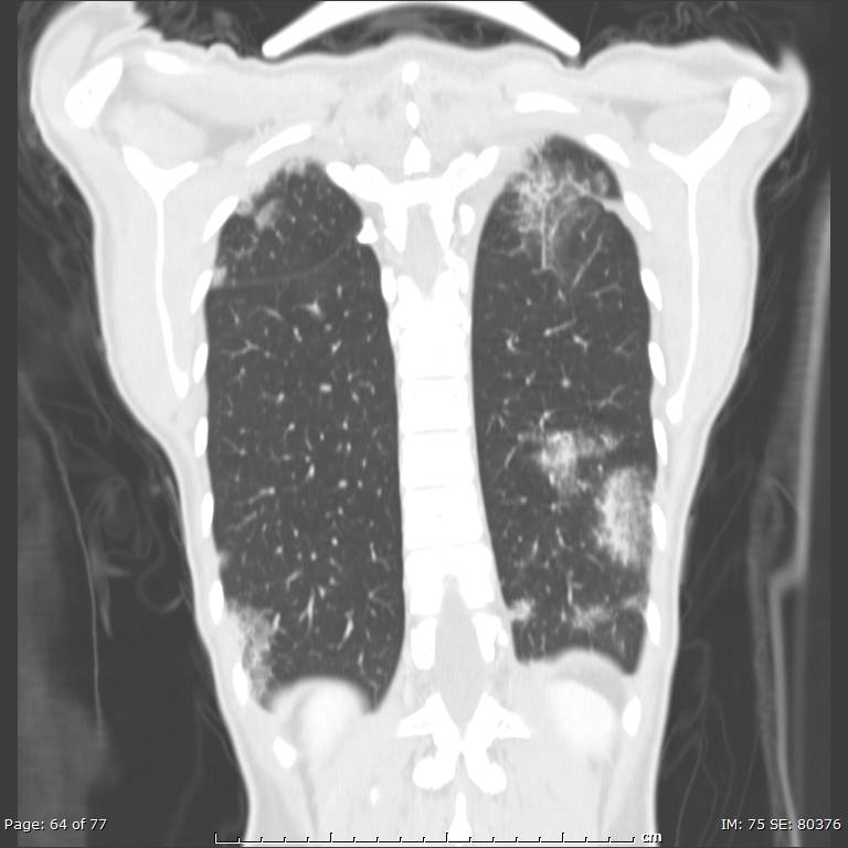 Acute eosinophilic pneumonia (Radiopaedia 48211-53073 Coronal lung window 44).jpg