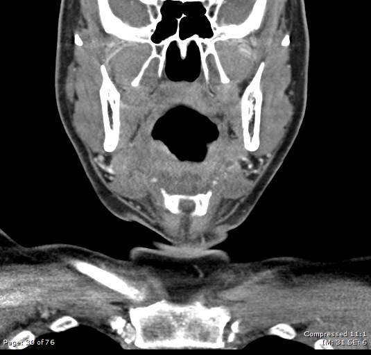 File:Acute epiglottitis (Radiopaedia 54375-60590 Coronal C+ arterial phase 30).jpg
