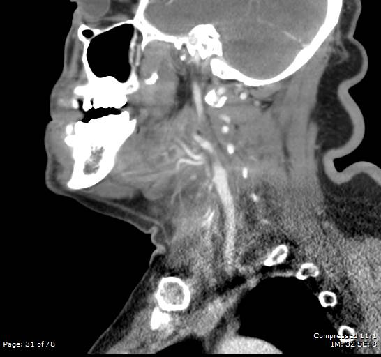 Acute epiglottitis (Radiopaedia 54375-60590 Sagittal C+ arterial phase 31).jpg