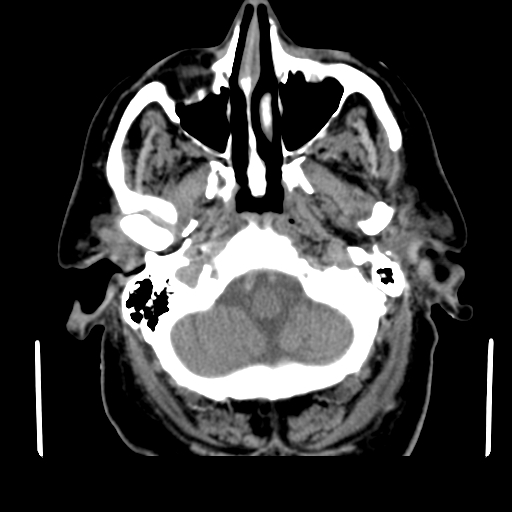 Acute hemorrhagic stroke (Radiopaedia 17507-17223 Axial non-contrast 8).jpg