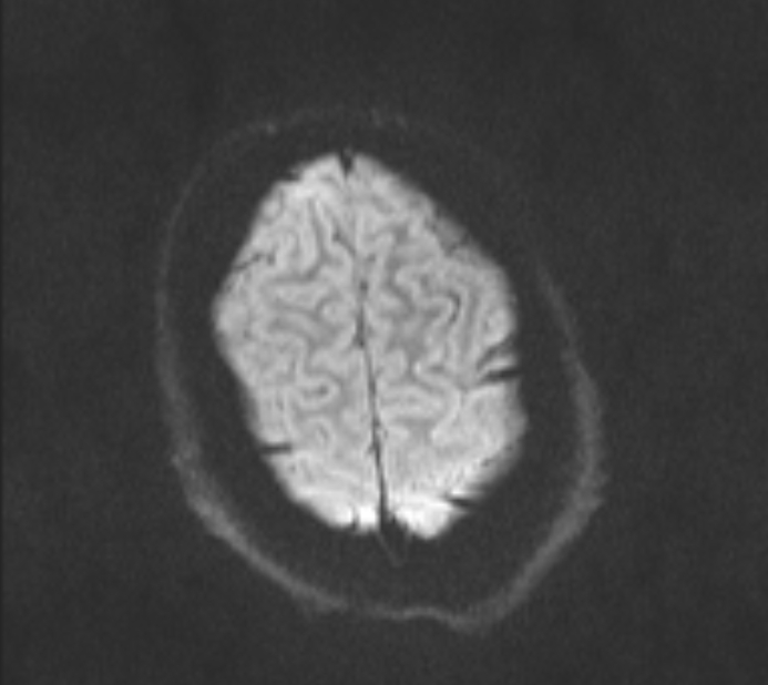 Acute ischemic stroke - posterior circulation territory (Radiopaedia 77670-89880 Axial DWI 44).jpg