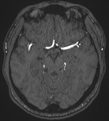 Acute left middle cerebral artery territory infarct with clot retrieval (Radiopaedia 47732-52433 Axial MRA 25).png