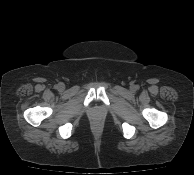 Acute mesenteric ischemia (Radiopaedia 80029-93316 Axial non-contrast 90).jpg