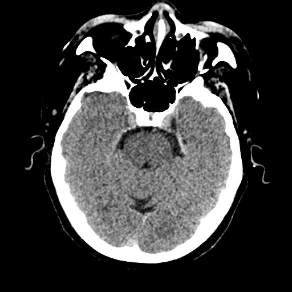 Acute middle cerebral artery territory infarct (Radiopaedia 52380-58283 Axial non-contrast 29).jpg