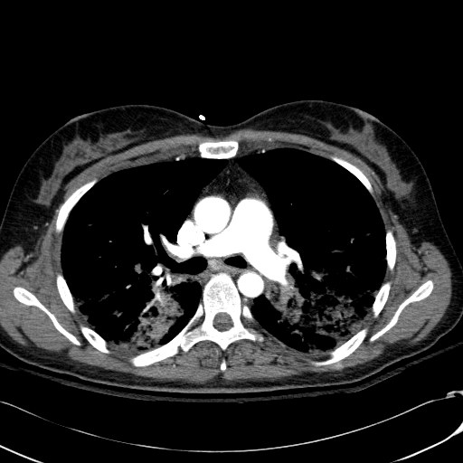 Acute myocardial infarction in CT (Radiopaedia 39947-42415 Axial C+ arterial phase 55).jpg