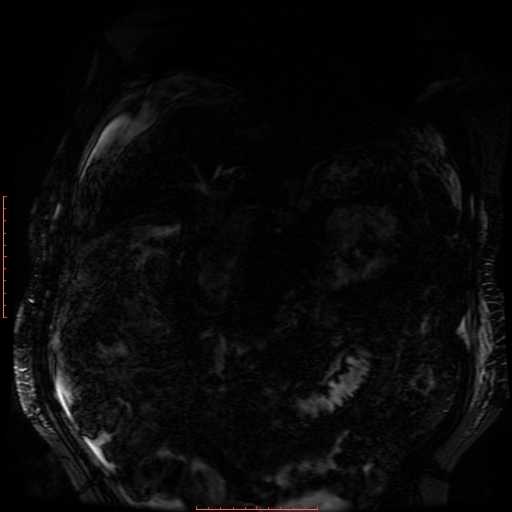 Acute necrotizing pancreatitis (Radiopaedia 28194-28448 Coronal MRCP 68).jpg