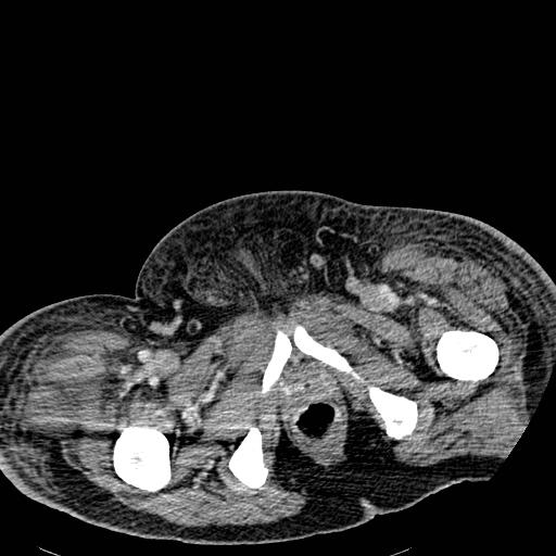 Acute pancreatic necrosis (Radiopaedia 13560-18501 Axial C+ portal venous phase 155).jpg