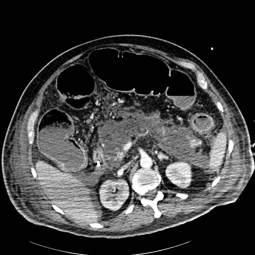 Acute pancreatic necrosis (Radiopaedia 13560-18502 Axial C+ portal venous phase 28).jpg
